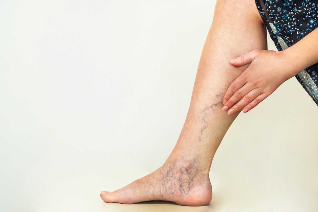 Spider Vein Removal